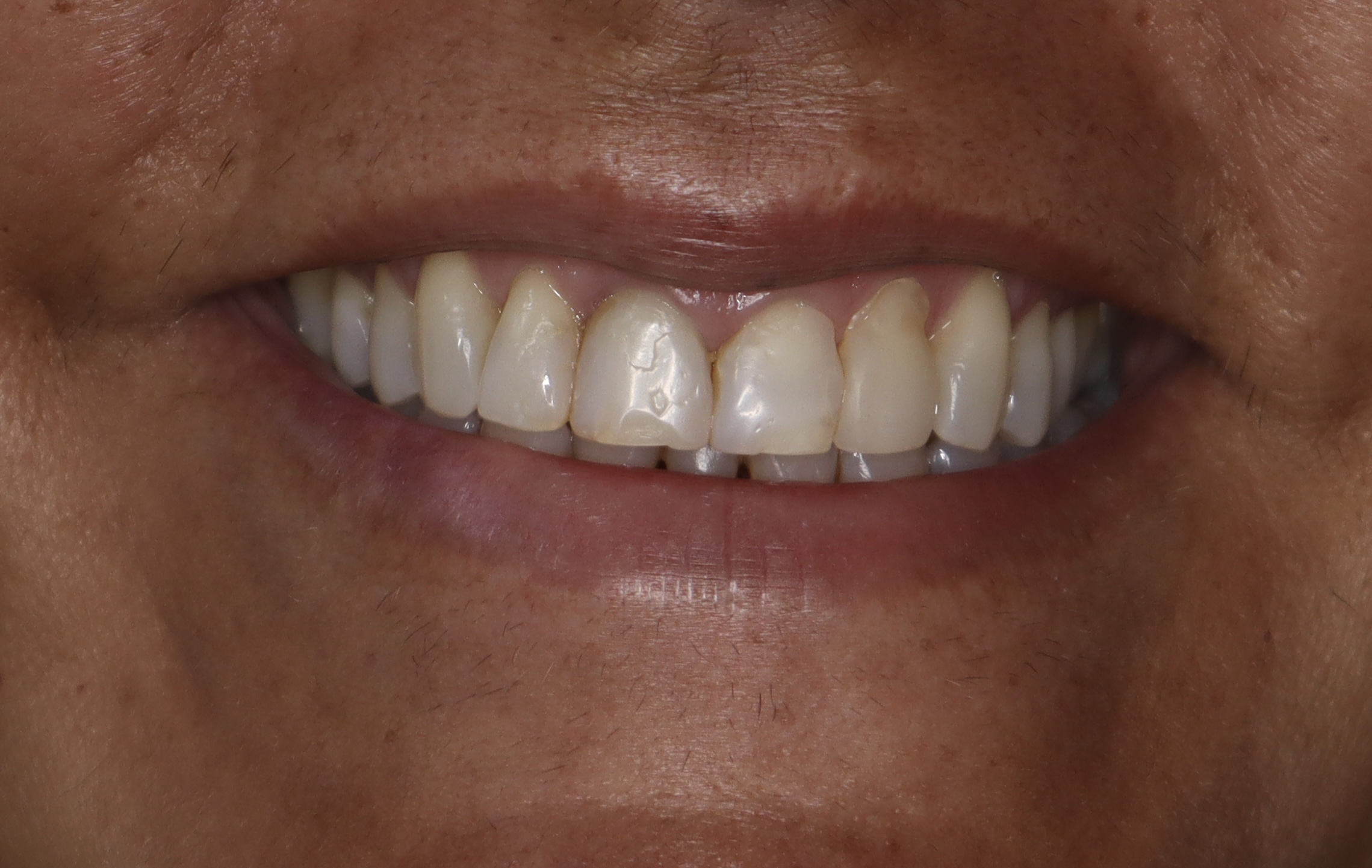 Antes: Diseño de sonrisa