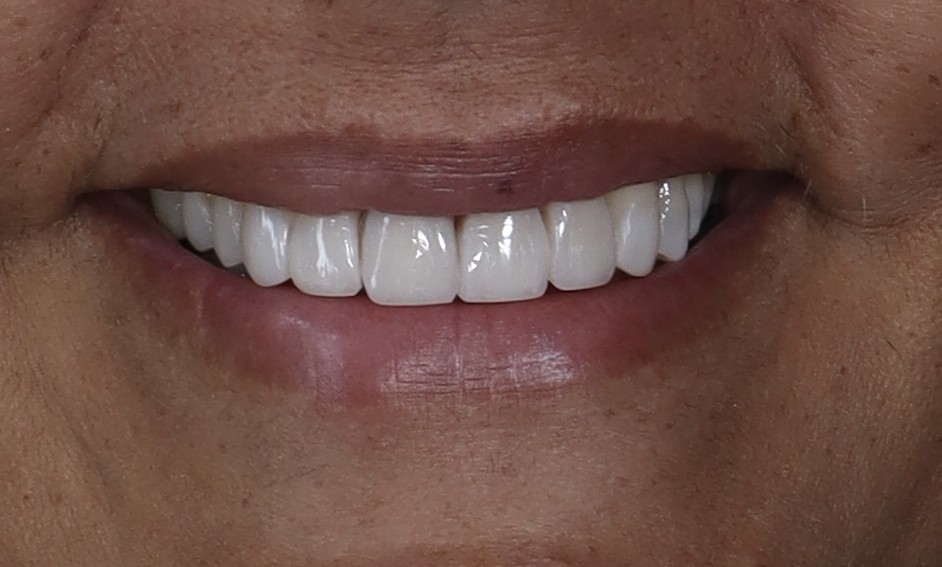 Después: Diseño de sonrisa