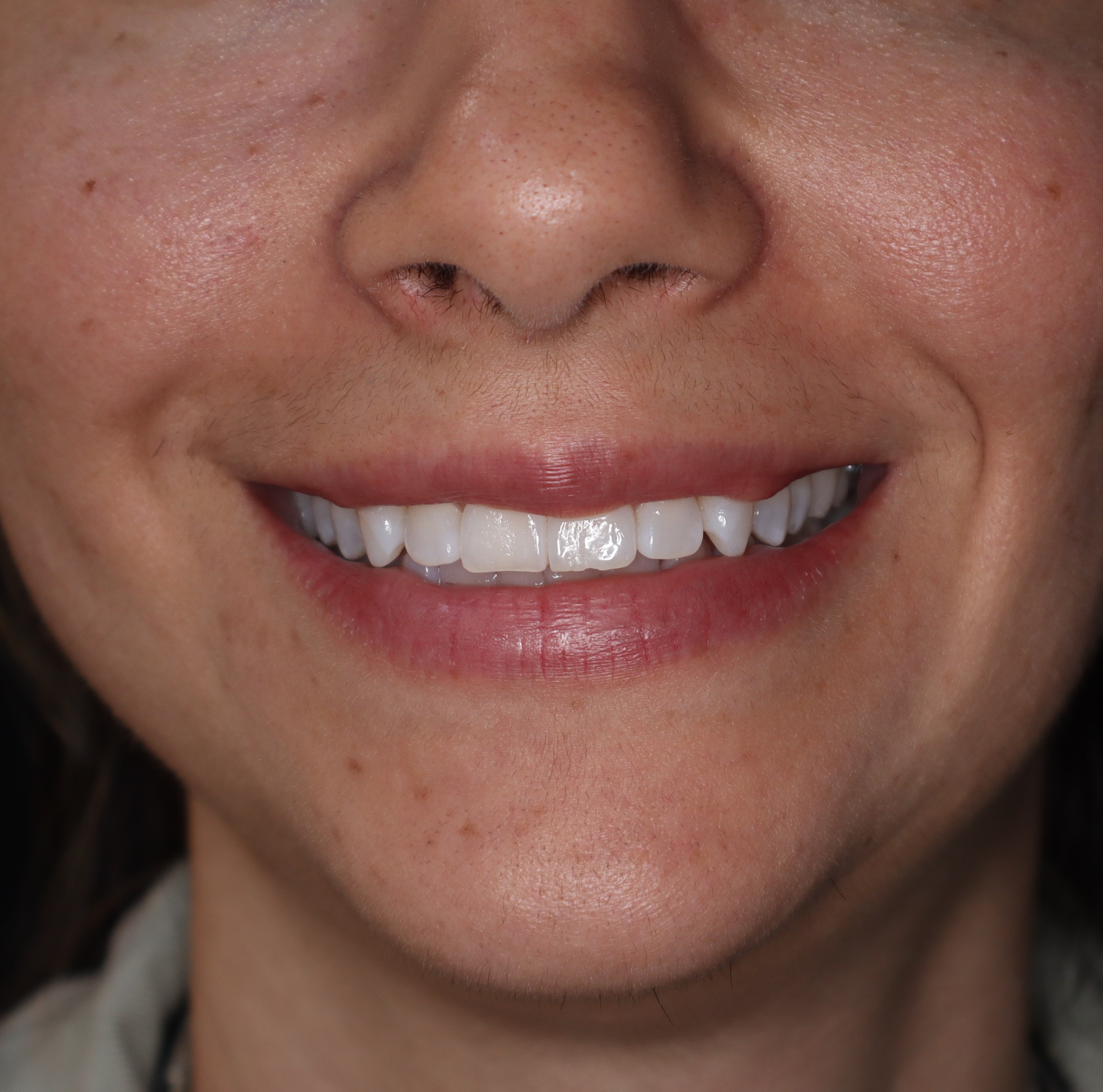 Antes: Blanqueamiento dental