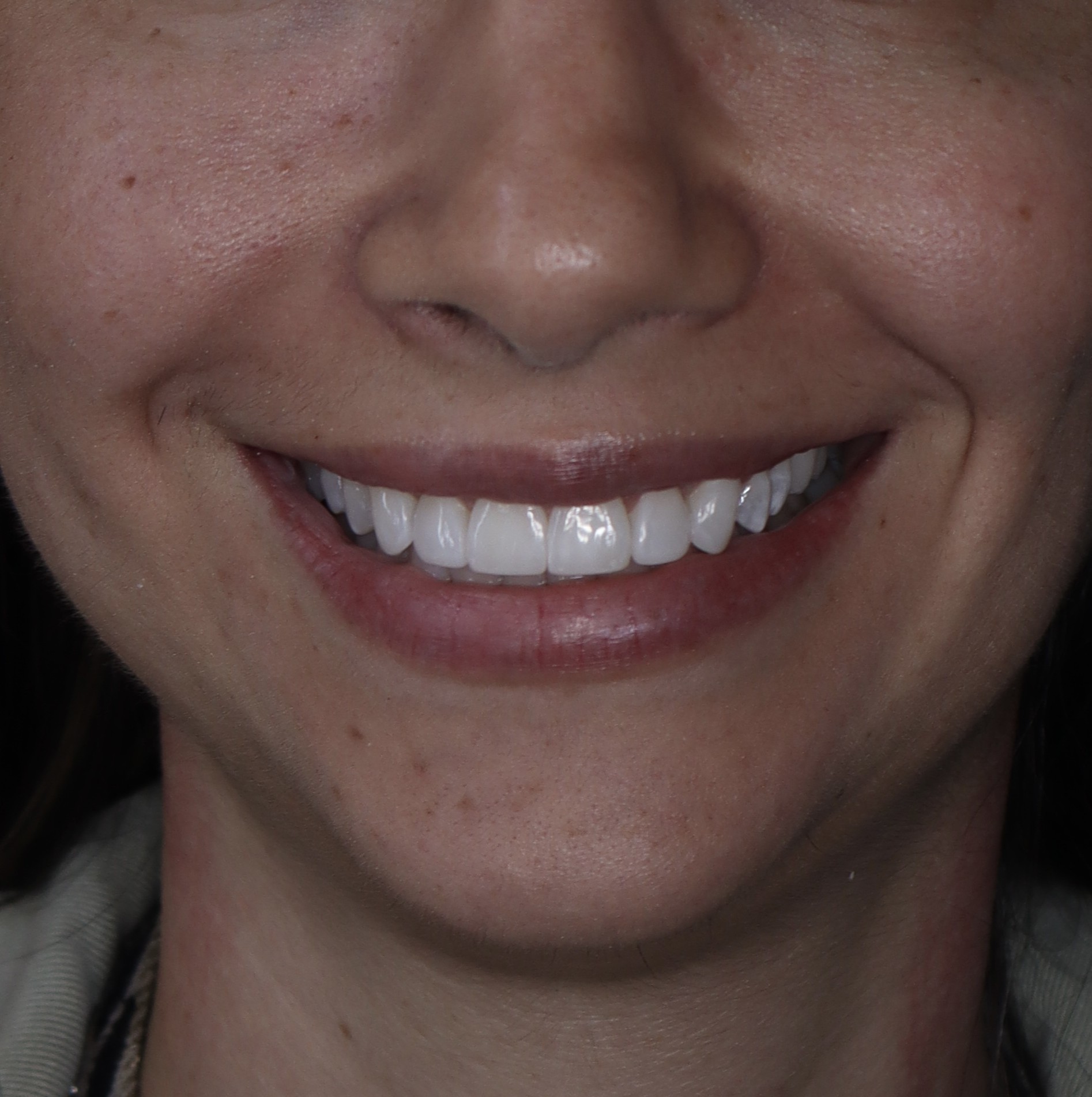 Después: Blanqueamiento dental