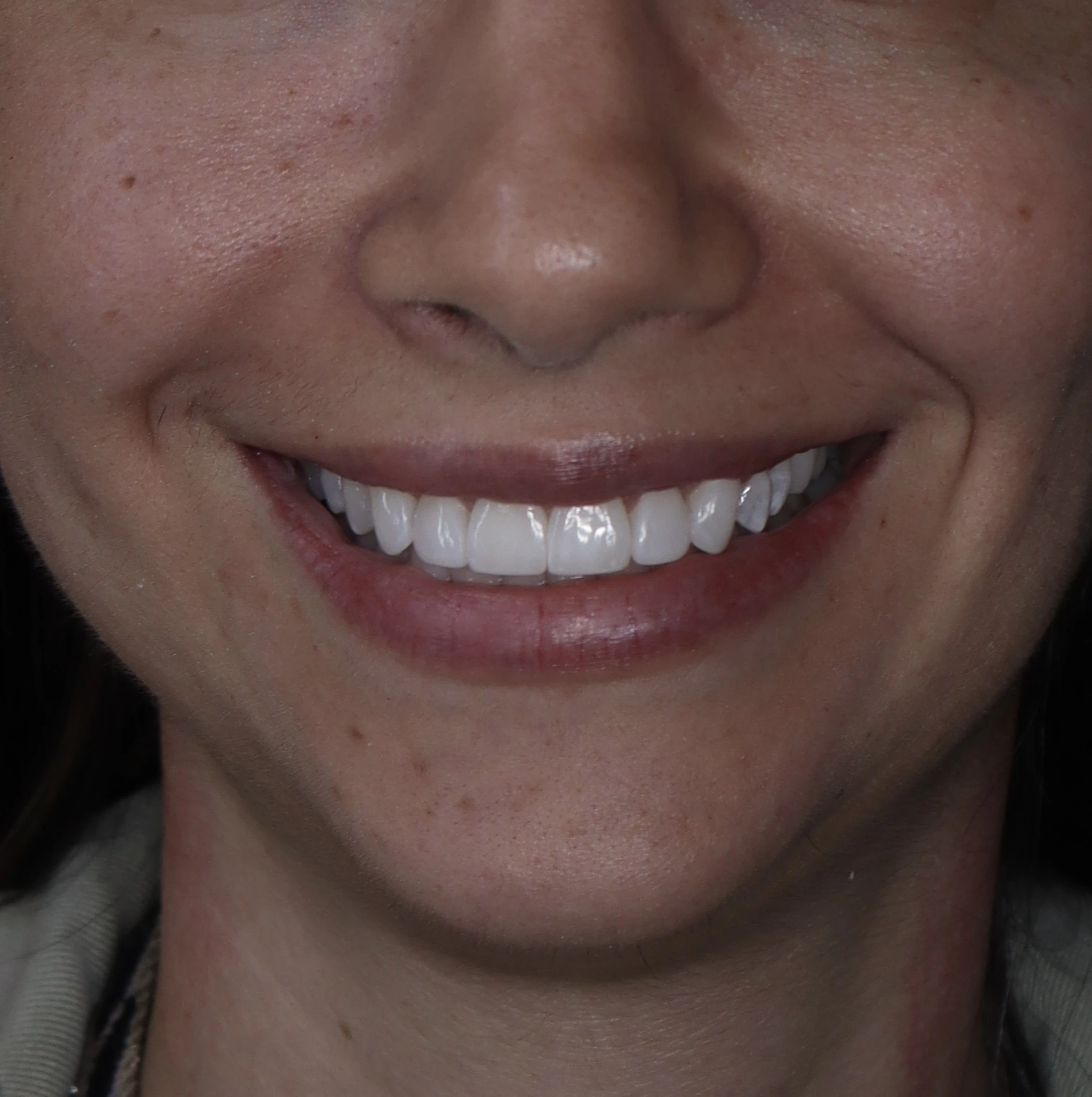 Después del blanqueamiento dental en La Odontología Medellín — caso 3, sonrisa natural