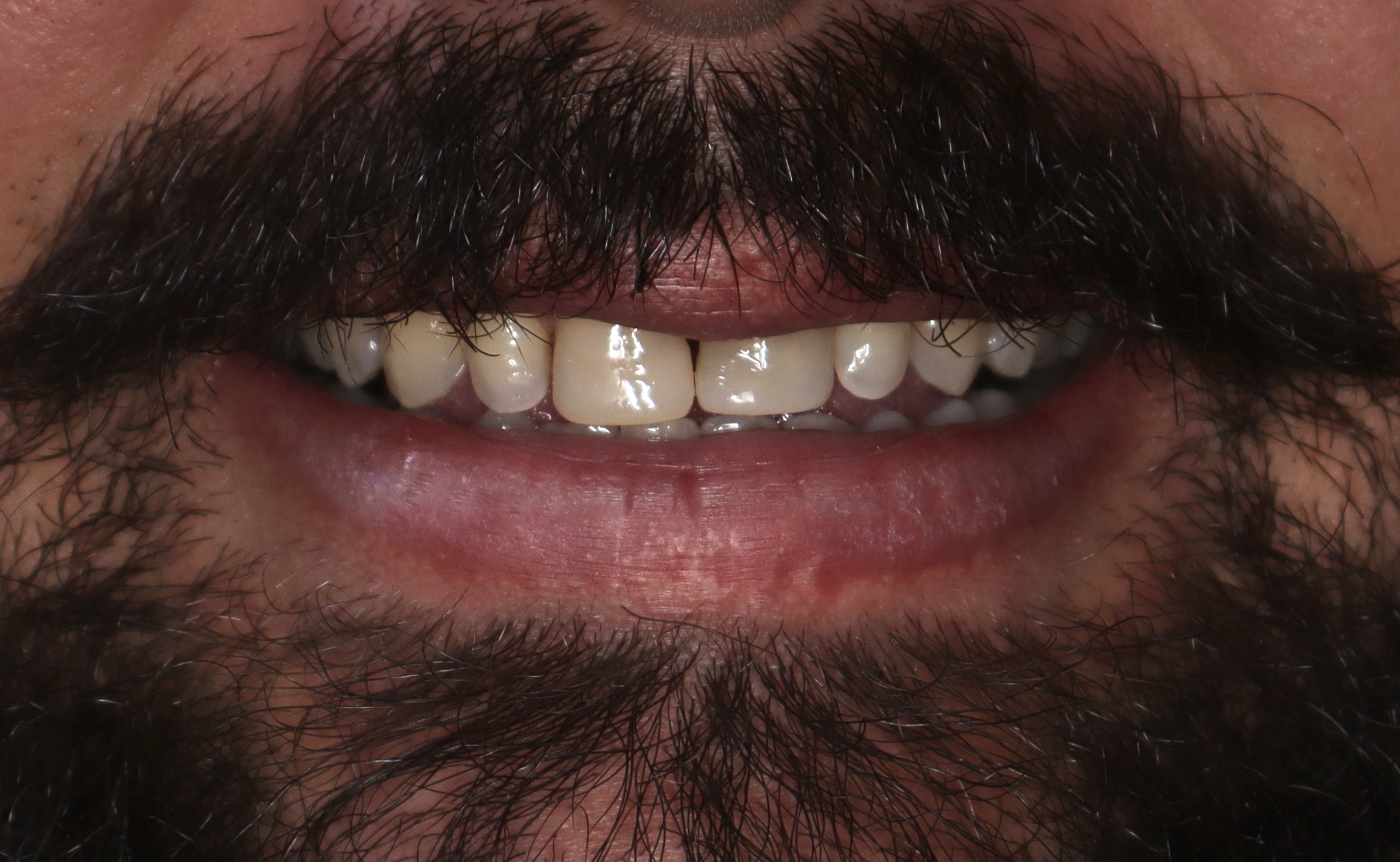 Antes: Ortodoncia estética