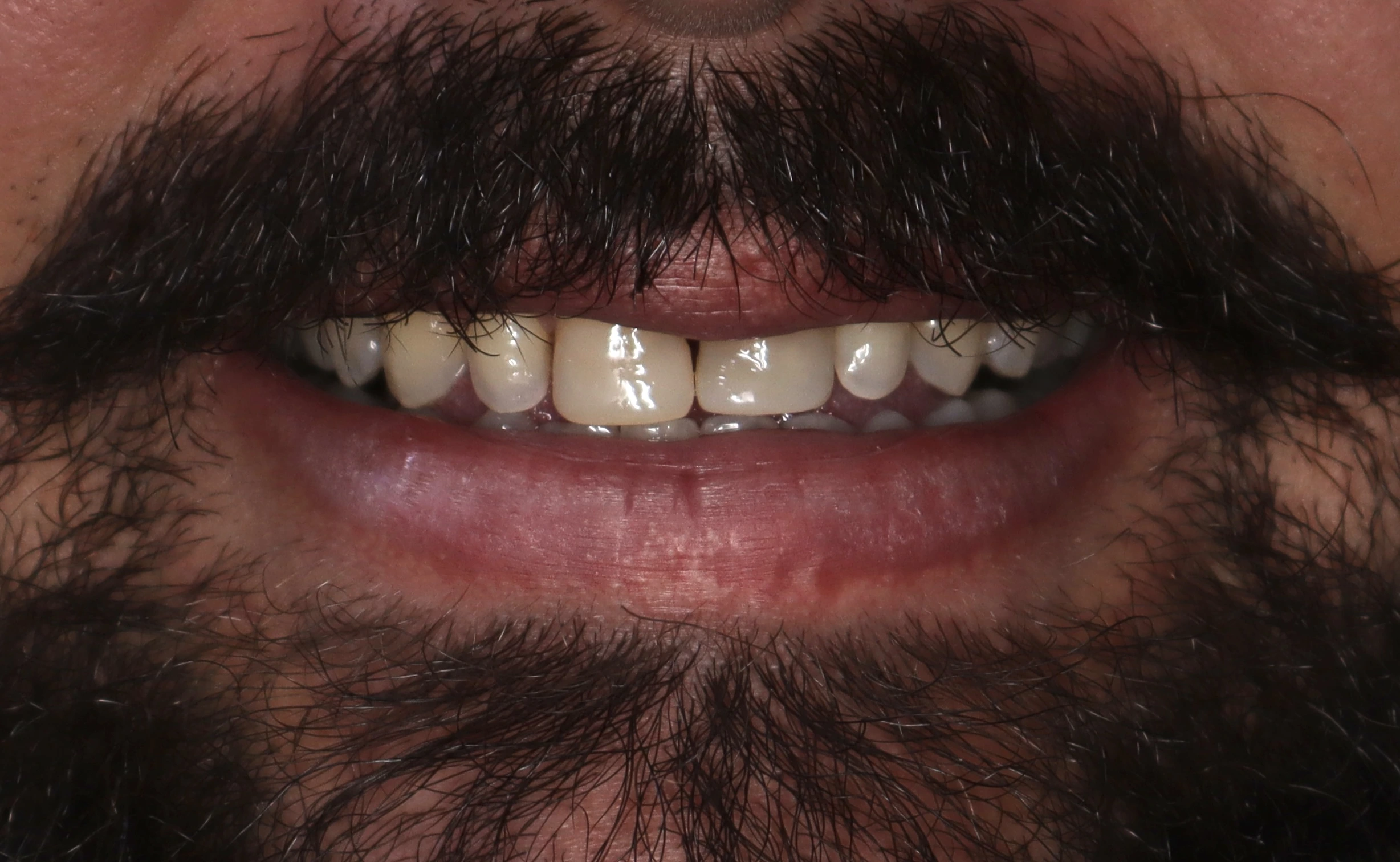 Antes del ortodoncia estética en La Odontología Medellín — caso 4