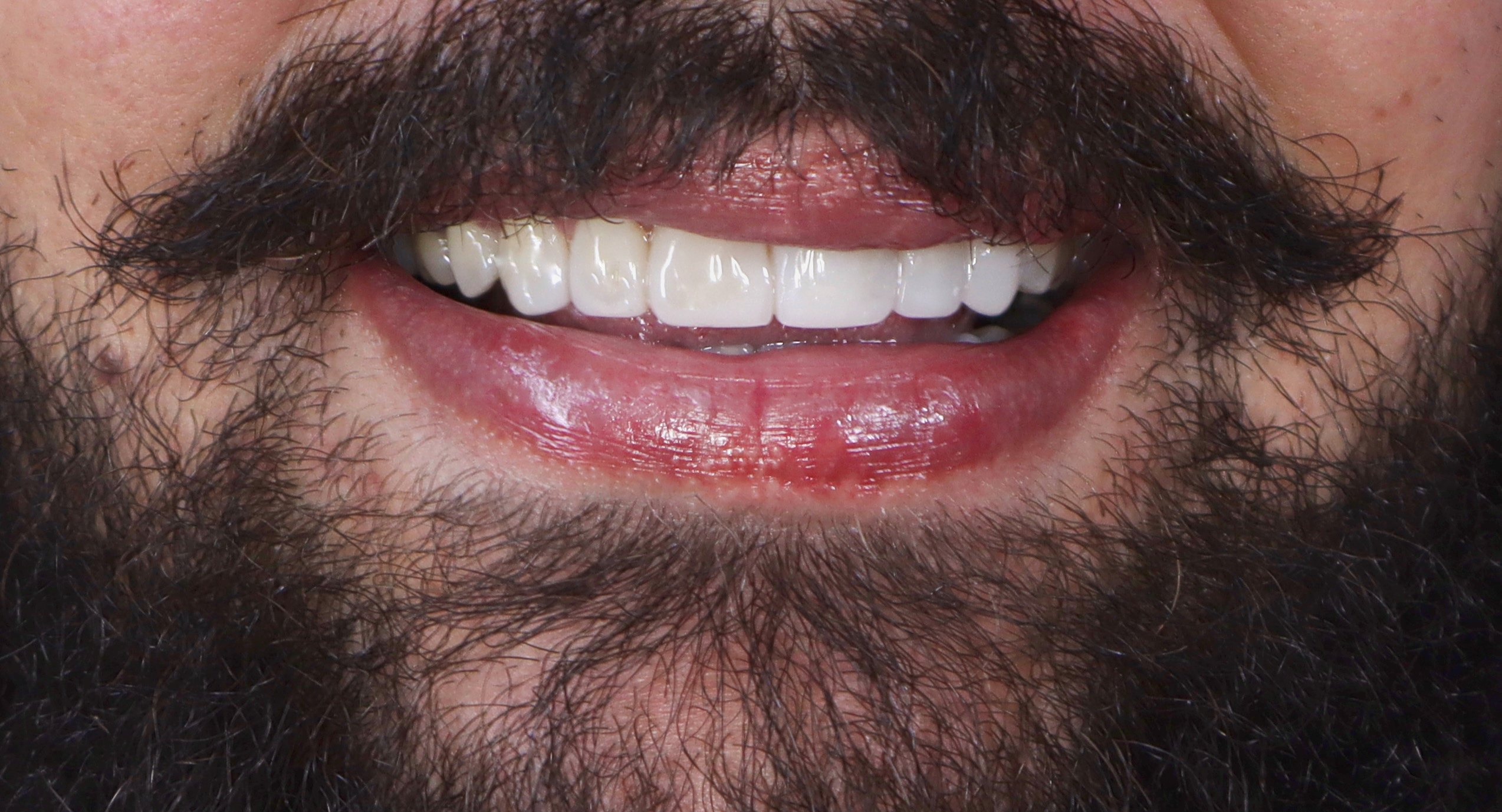 Después: Ortodoncia estética