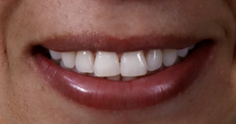 Antes: Implantes dentales