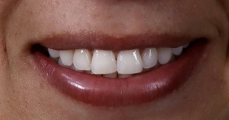 Antes del implantes dentales en La Odontología Medellín — caso 5