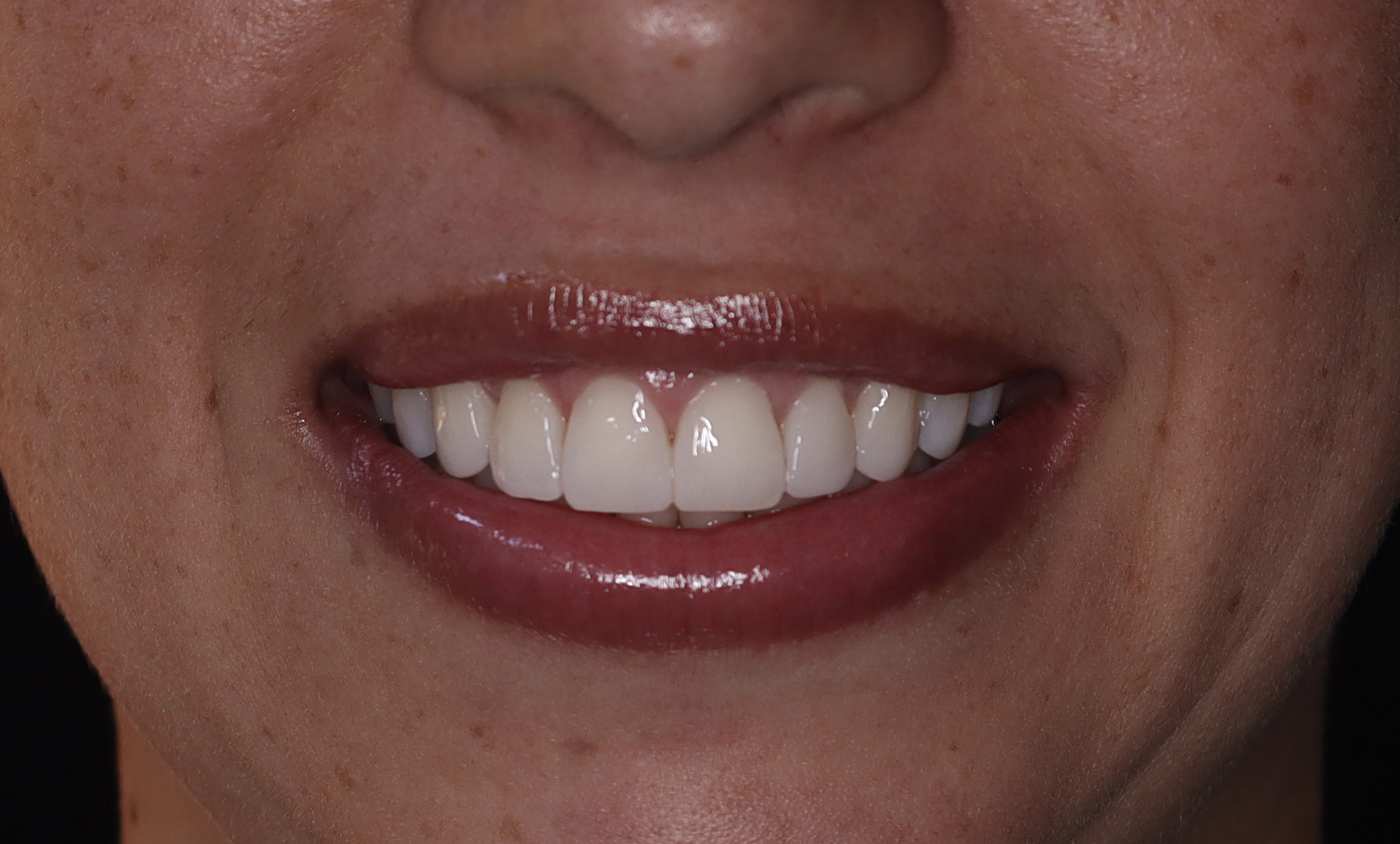 Después: Implantes dentales