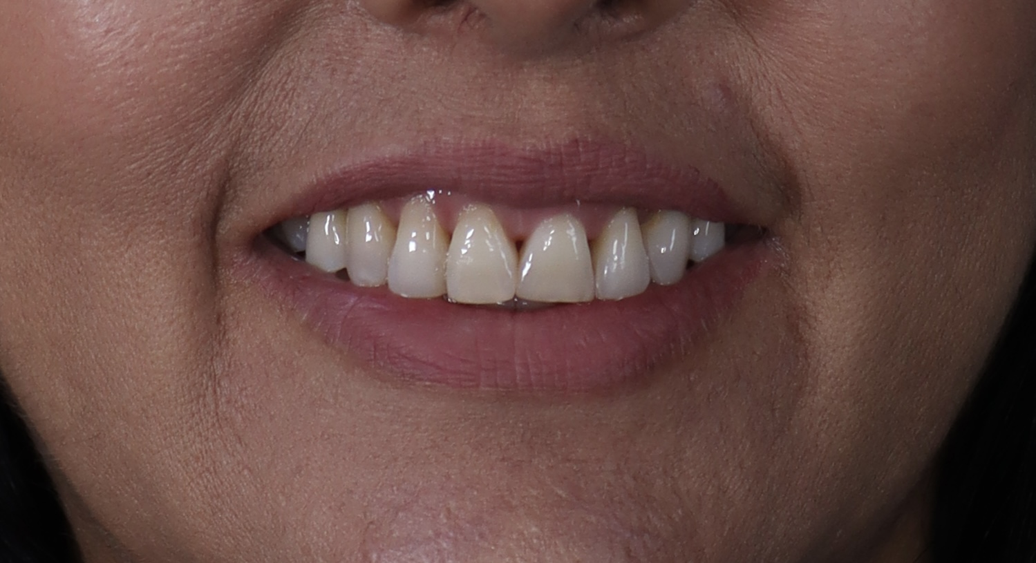 Antes: Rehabilitación oral