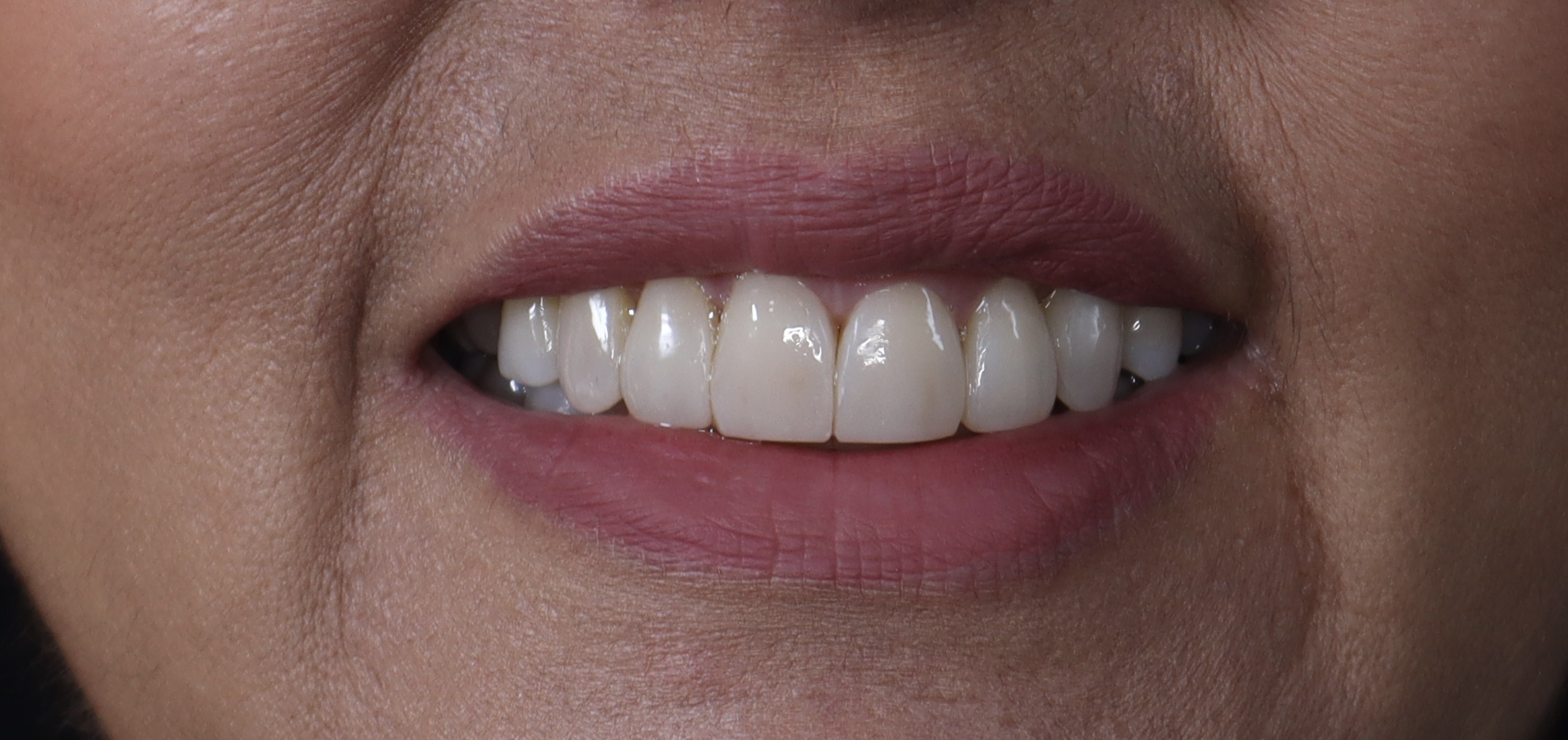 Después: Rehabilitación oral
