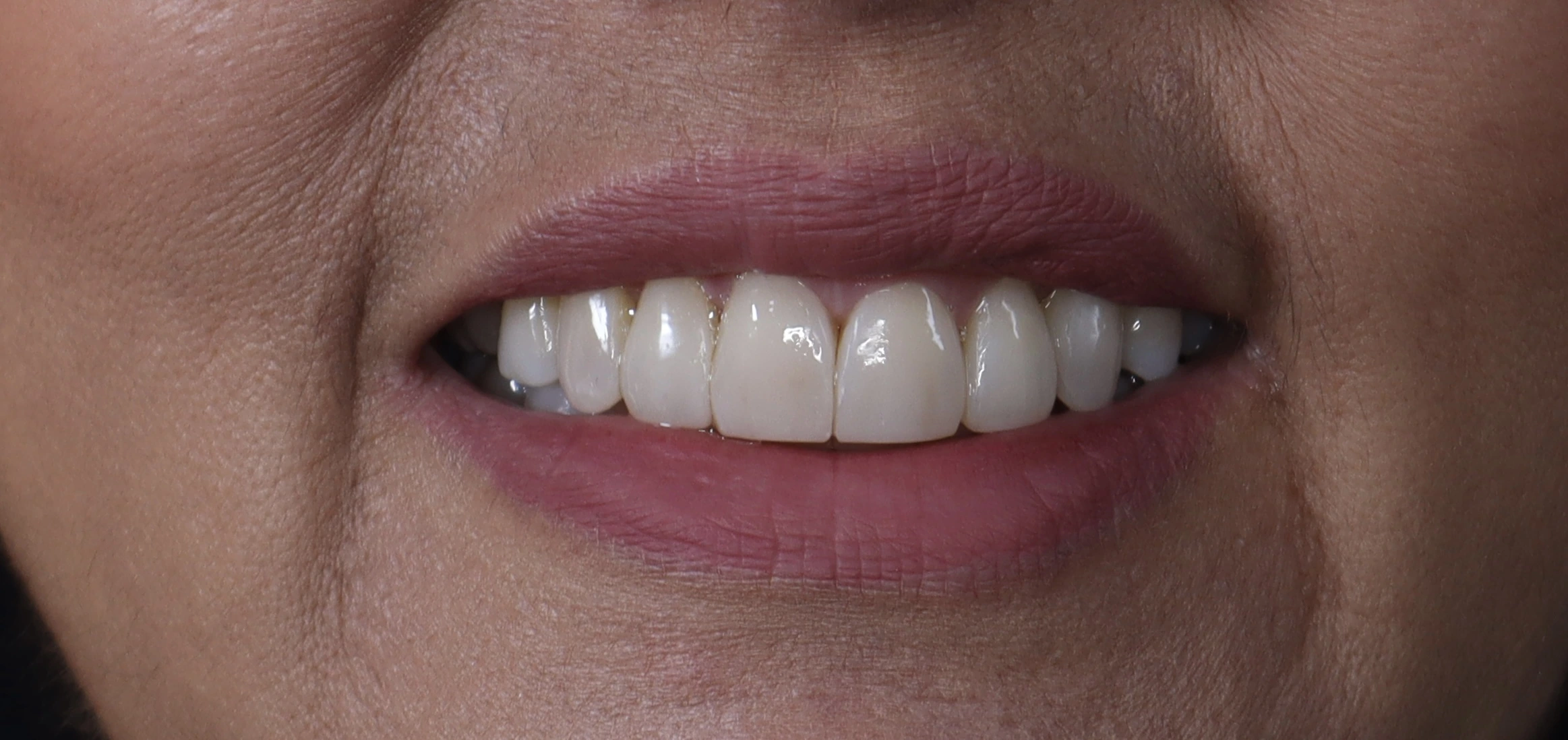 Después del rehabilitación oral en La Odontología Medellín — caso 6, sonrisa natural