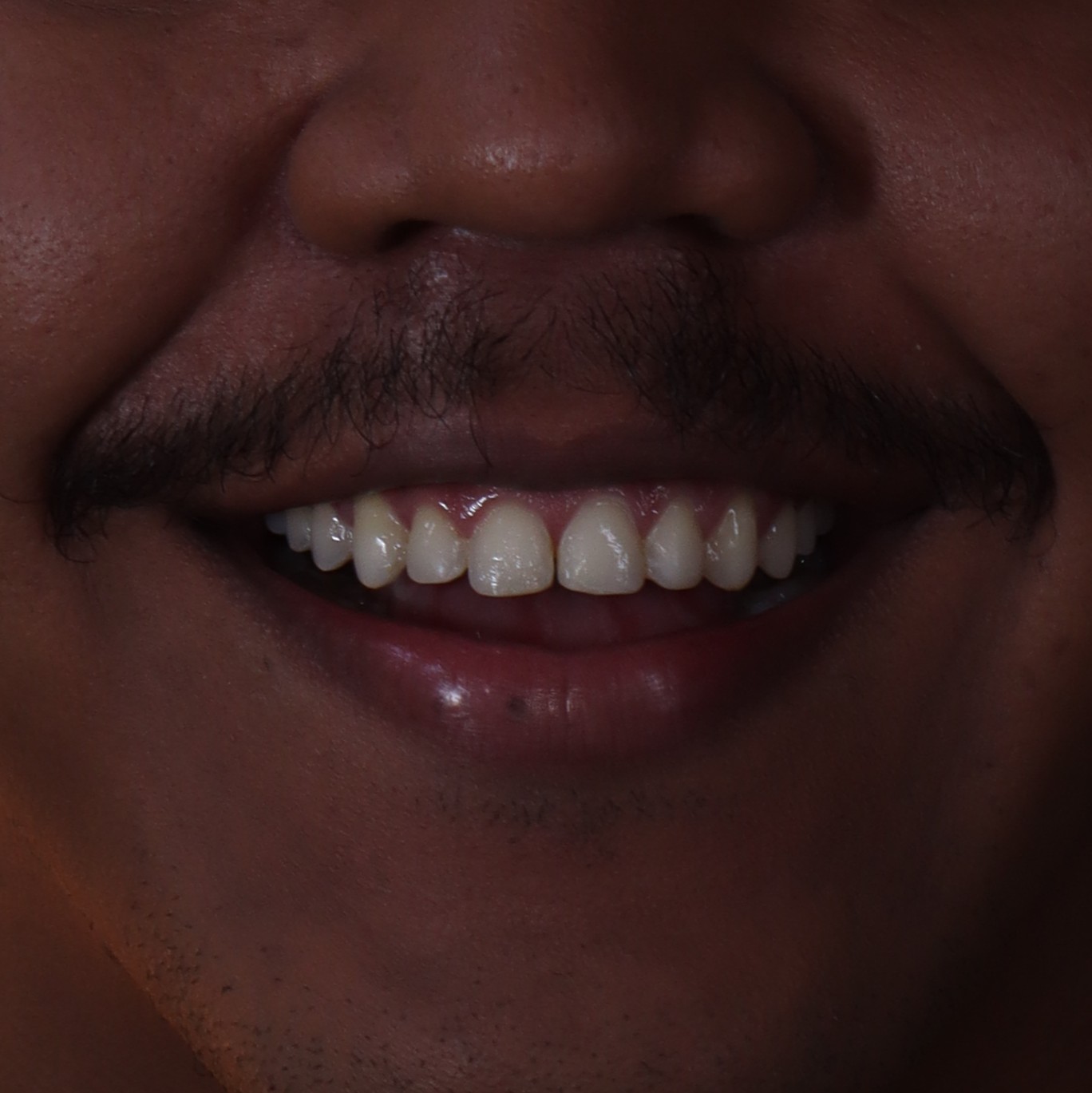 Antes: Microdiseño dental