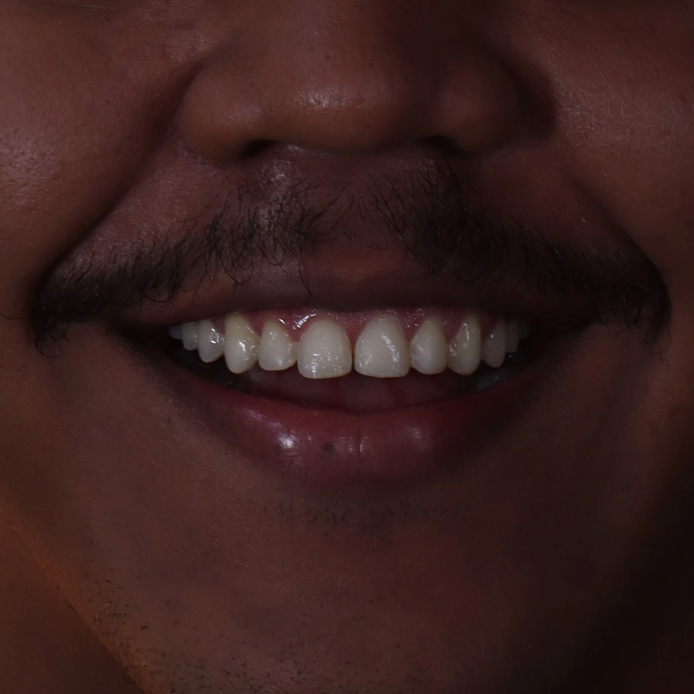 Antes del microdiseño dental en La Odontología Medellín — caso 2