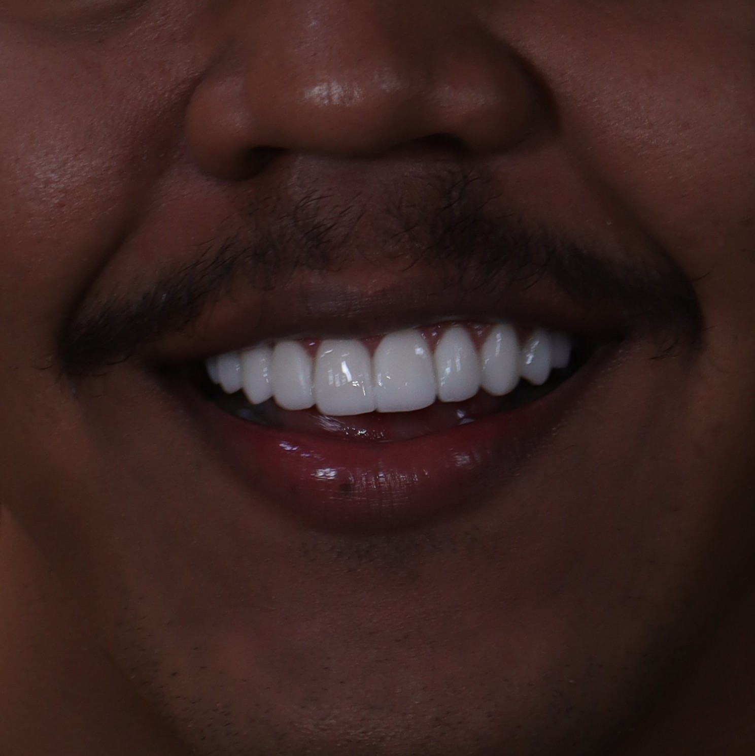 Después: Microdiseño dental